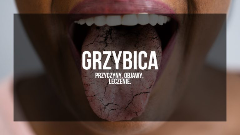 Grzybica - Przyczyny, Objawy, Leczenie: Na obrazie widzimy zbliżenie na otwarte usta, z widocznym językiem, który ma charakterystyczne zmiany skórne, mogące sugerować infekcję grzybiczą. Tekst na grafice „Grzybica - Przyczyny, Objawy, Leczenie” wskazuje, że obraz jest związany z artykułem lub prezentacją dotyczącą tematu grzybicy, wyjaśniającym przyczyny, objawy i metody leczenia tej powszechnej infekcji. Wizualizacja ta ma na celu podkreślenie zagrożeń związanych z grzybicą i jest przeznaczona dla osób poszukujących informacji na temat rozpoznawania i radzenia sobie z tą chorobą.